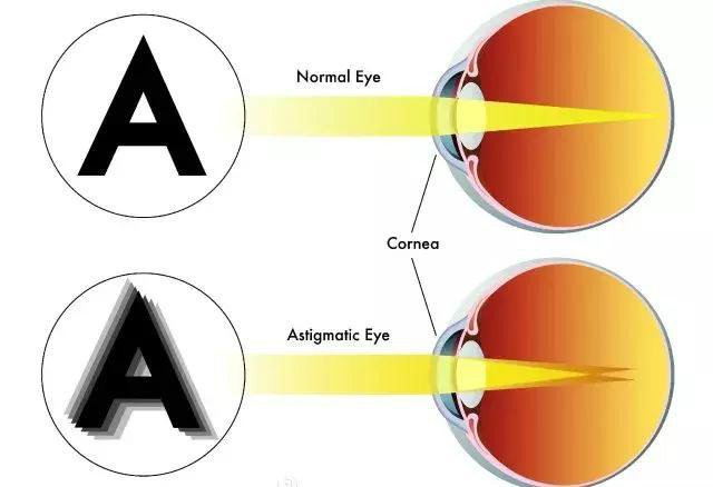 乱視が治るの？近視乱視メガネおすすめ。